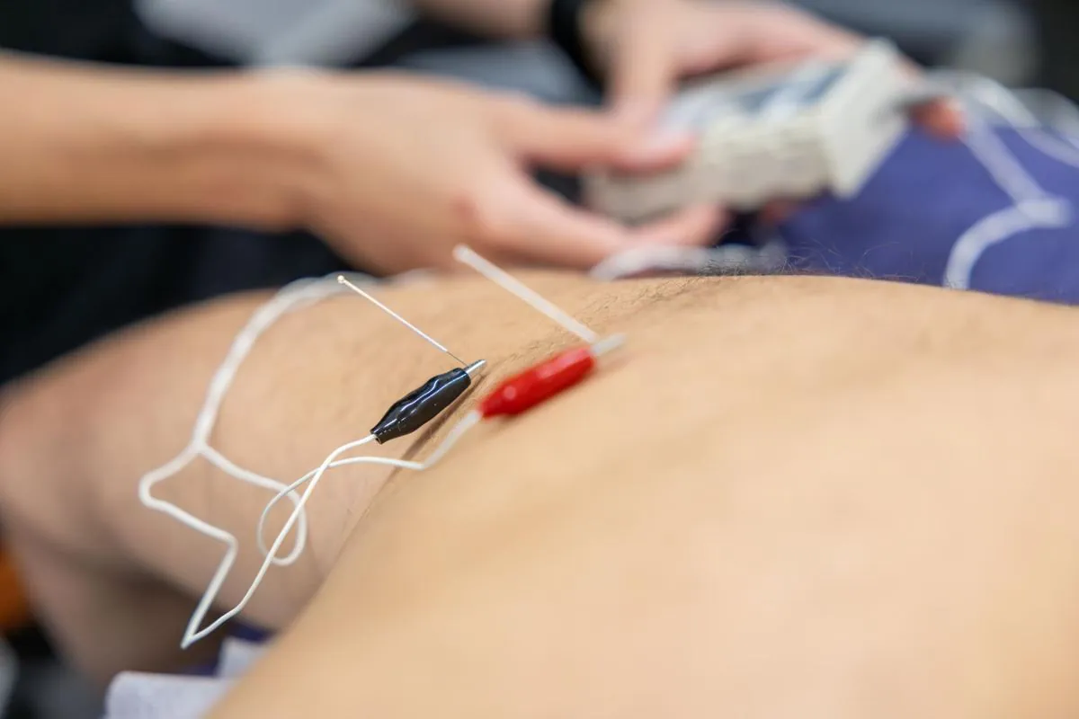 Neuromodulació percutània